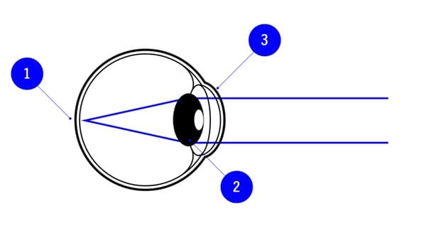 Schematische Darstellung eines Auges mit markierten Punkten und Lichtstrahlen; erklärt den Verlauf des Sehens durch Linse und Hornhaut.
