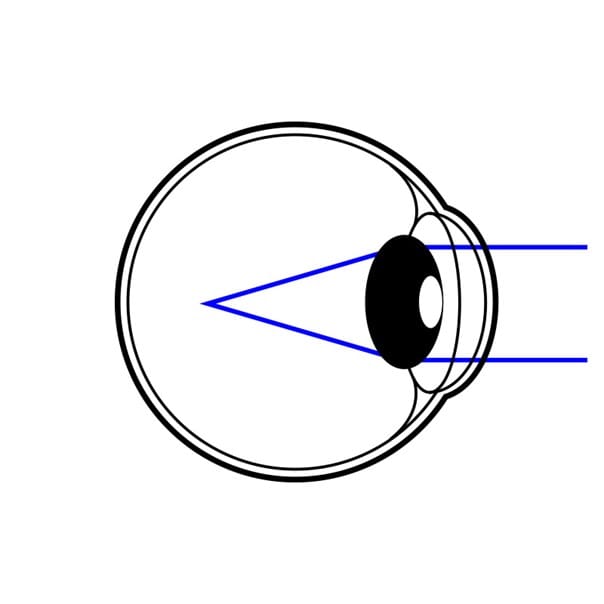 Schematische Grafik eines Auges mit Fokuspunkt hinter der Netzhaut; stellt Weitsichtigkeit (Hyperopie) dar.