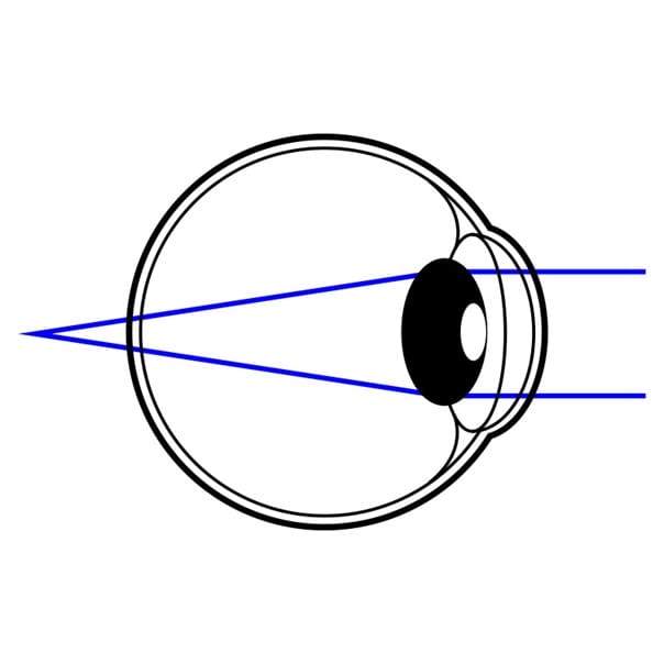 Illustration eines Auges mit verlagerter Fokusebene vor der Netzhaut; visualisiert Kurzsichtigkeit (Myopie).