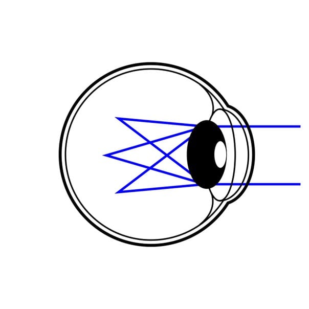 Schematische Darstellung eines Auges mit mehreren Lichtstrahlen; zeigt Brechung und Fokus bei Presbyopie (Altersweitsichtigkeit).