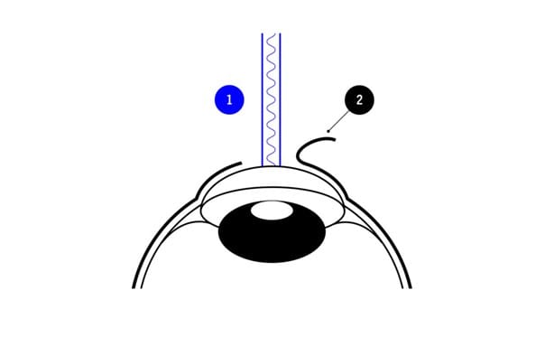 Schematische Darstellung eines Auges mit chirurgischem Instrument; zeigt präzisen Eingriff an der Hornhaut während einer Behandlung.
