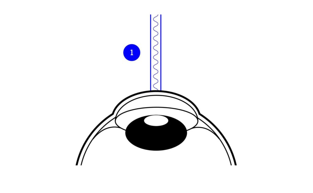 Grafik eines Auges mit geöffnetem Schnittbereich und Tropfen darüber; zeigt Beginn einer chirurgischen oder diagnostischen Prozedur.