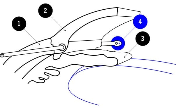 Schematische Darstellung eines chirurgischen Instruments am Auge; veranschaulicht einen operativen Eingriff am vorderen Augenabschnitt.